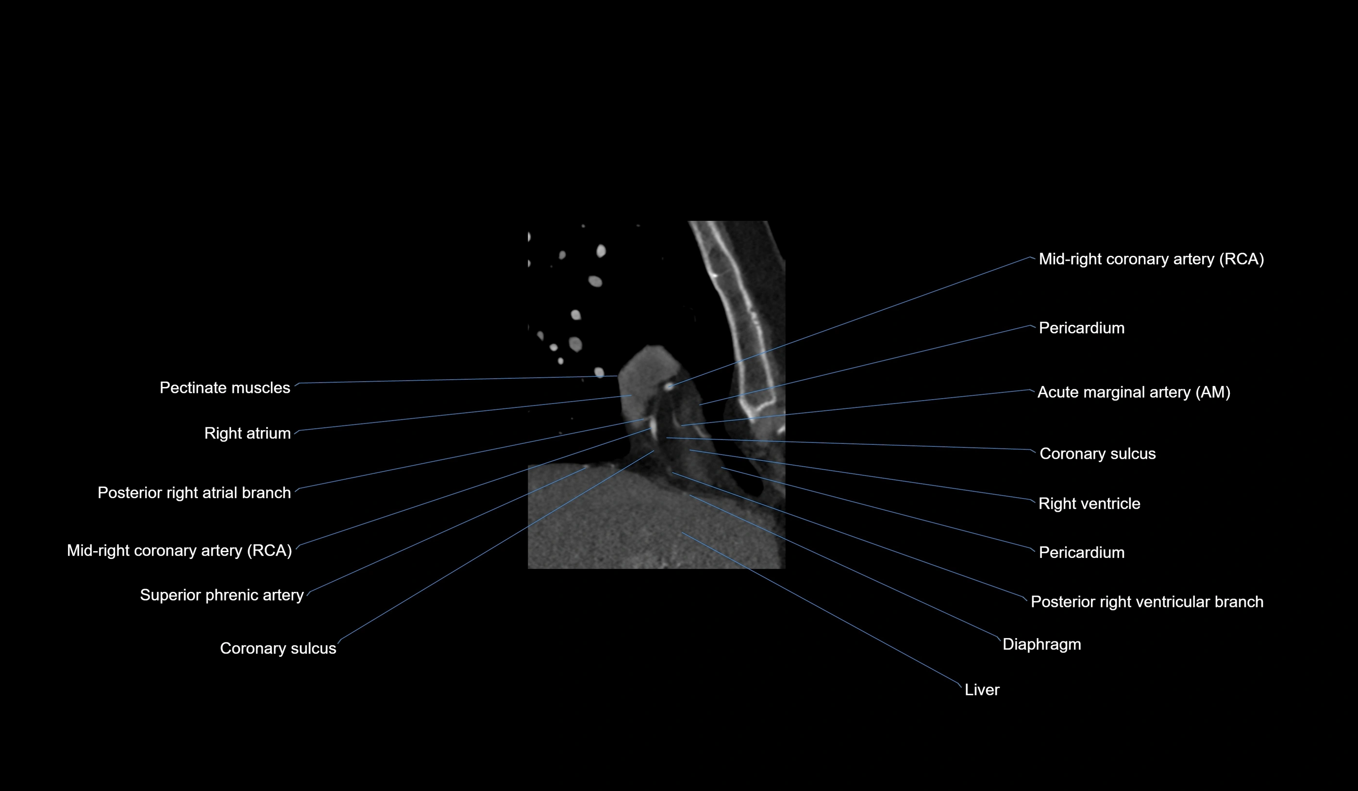 CT heart (coronary angiogram) 2 chamber view cross sectional anatomy labelled radiology image-00039.webp
